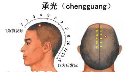 承光穴→治頭痛、鼻炎