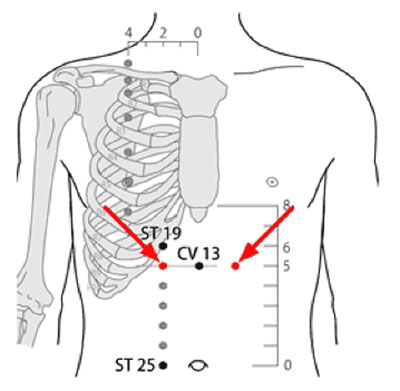 承滿穴→治胃痛、胃痙攣