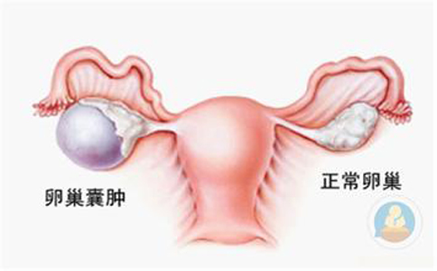 卵巢囊腫，抱腿壓涌泉穴，給你愛心呵護(hù)